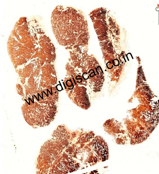 MDS Immunohistochemistry (IHC) Digital Slides Set